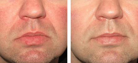 Skin Redness and Flushing Before and After