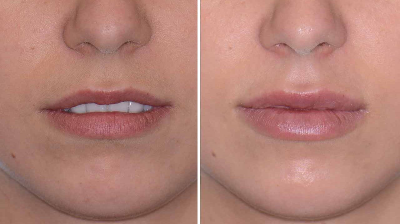 Lip Echancement Before and After