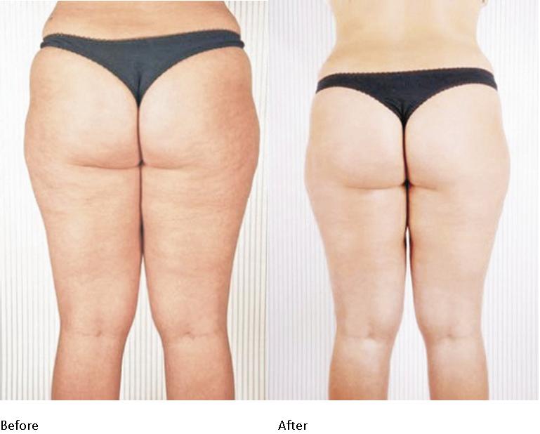 Before and After
